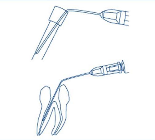 Miraject-Biegen-0309-500x452-1