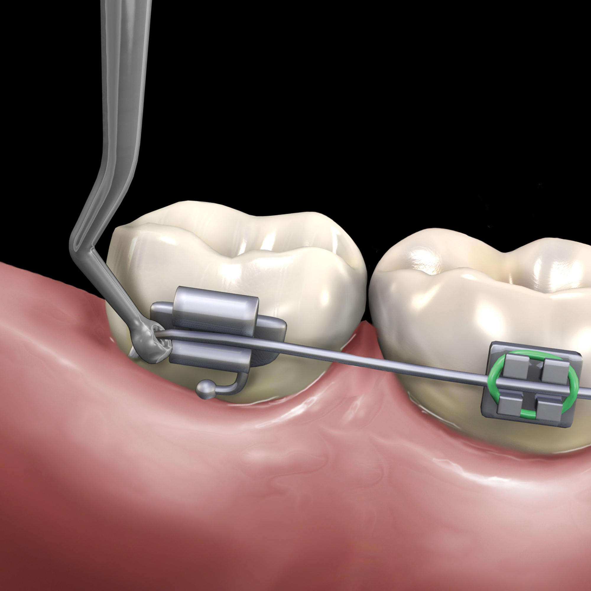 678-506__678-506-clinical-illustration_2_rgb