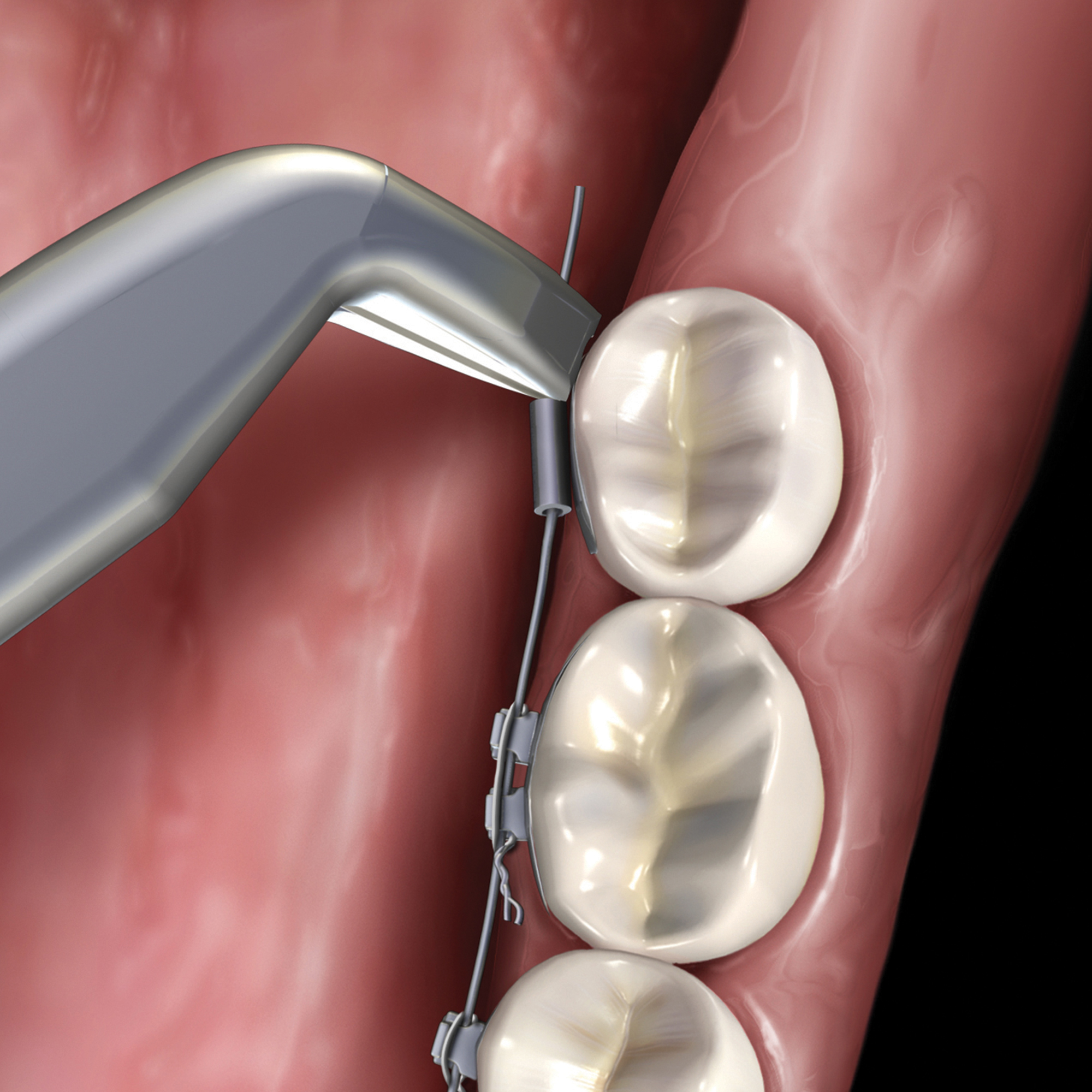 678-700__678-700_clinical_illustration_rgb