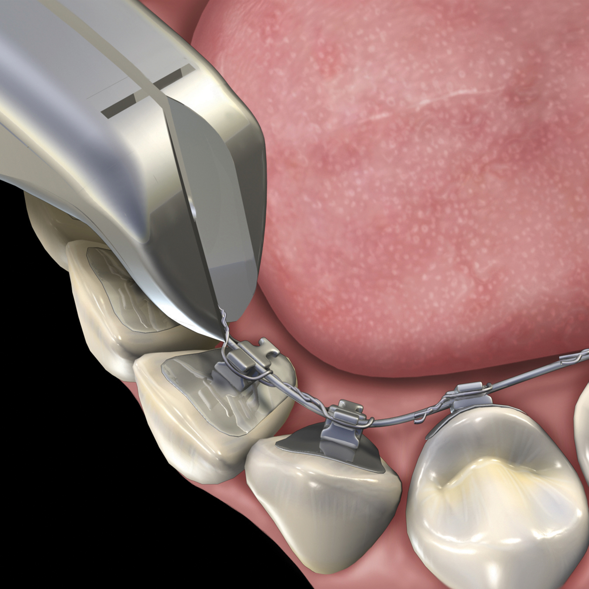 678-701__678-701_clinical_illustration_rgb
