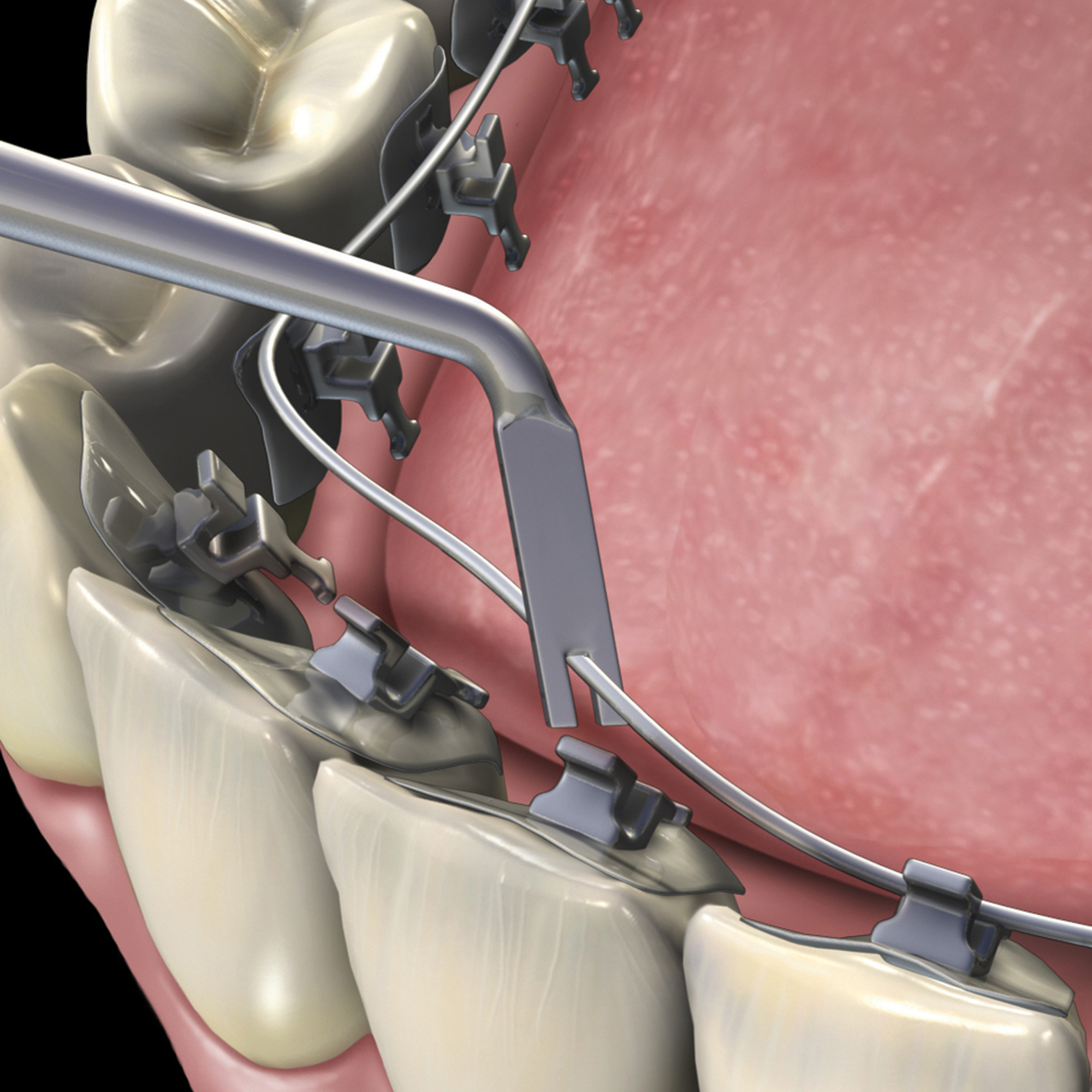678-706__678-706_clinical_illustration_1_rgb