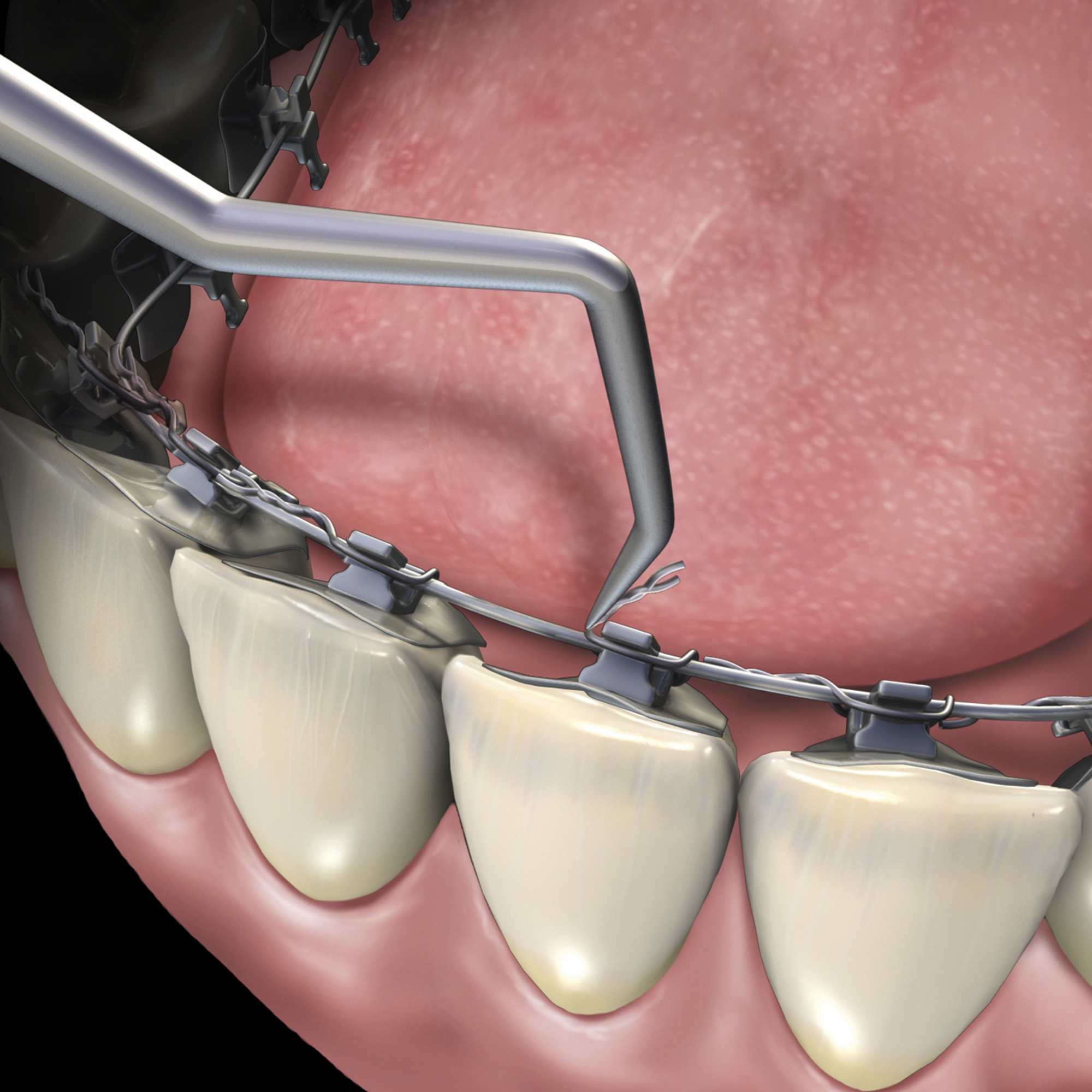 678-706__678-706_clinical_illustration_2_rgb