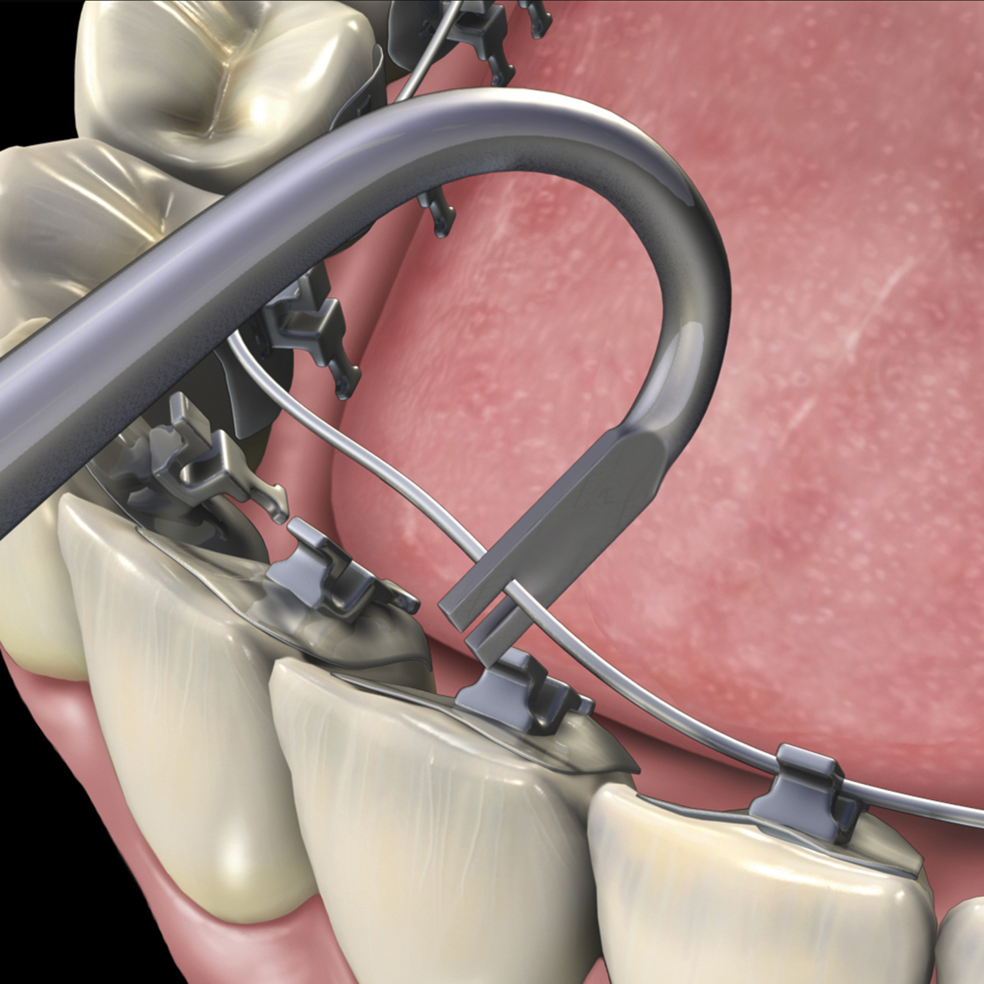 678-707__678-707_clinical_illustration_rgb