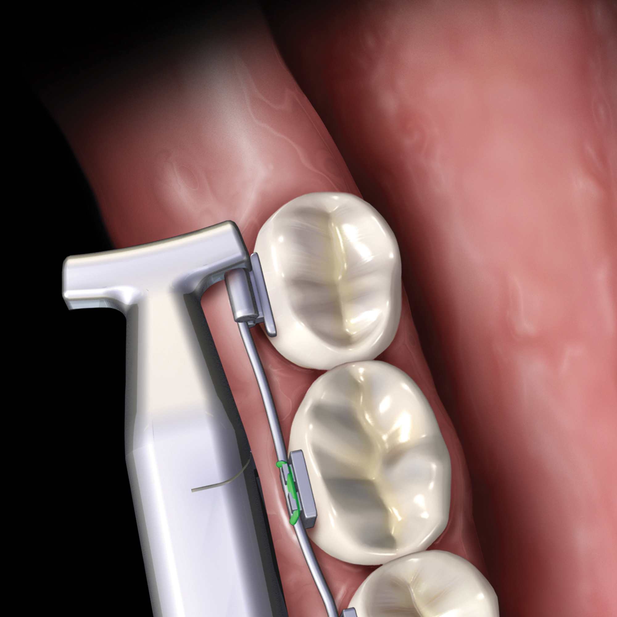 678-502__678-502-clinical-illustration_1_rgb