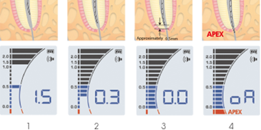 endo_IPEX_01